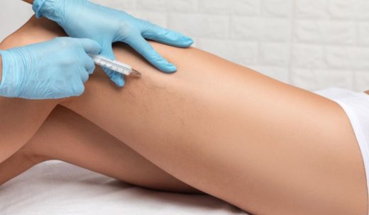 Thread Vein Removal Leicester